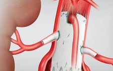 The Zenith Alpha Thoracic Stent Graft from Cook Medical